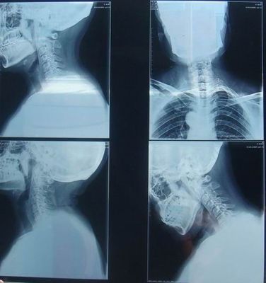 قیمت خوب کاغذ پزشکی مقاوم در برابر خراش KND-K فیلم تصویربرداری خشک برای آزمایش رادیوگرافی آنلاین