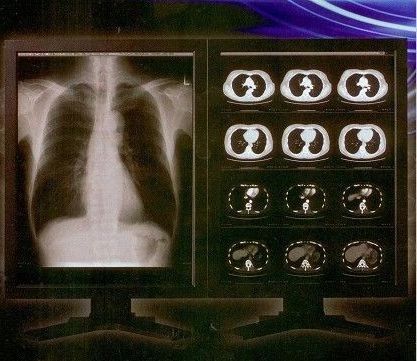 فیلم روشن X روشن دیجیتال ، فیلم شفاف لیزر پزشکی Konida