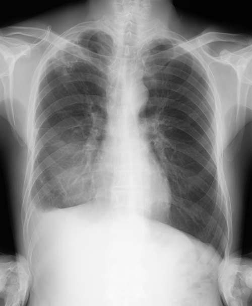 فیلم خشک X X-ray 14 x 17 ، فیلم تصویربرداری خشک پزشکی CT فوجی