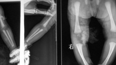 Good price تصویربرداری پزشکی با لیزر X 20c 25cm ، فیلم DT1B / DT2B Agfa X Ray فیلم آنلاین