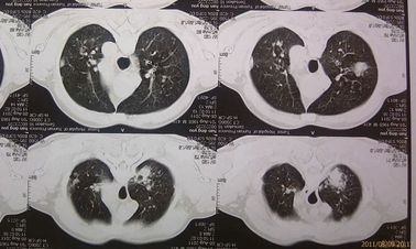 Double Layer DT2B Medical خشکی فیلم X Ray برای چاپگر حرارتی Agfa