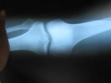 Good price کاغذ فیلم Xray پزشکی پزشکی 25cm * 30cm مقاوم در برابر خراش برای چاپگر لیزری Konida آنلاین