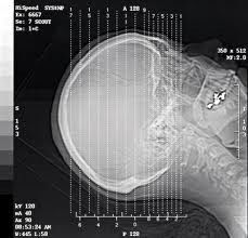 Good price فیلم خشک شده با لیزر نقره ای هالید X ray ، فیلم شفافیت 8 × 10in آنلاین